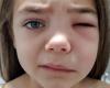 une petite fille ne pouvait plus ouvrir l’œil à cause d’un gonflement provoqué par un abcès