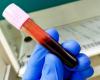 un nouveau test sanguin pour mesurer la réponse immunitaire au virus d’Epstein Barr