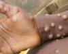 MPOX frappe durement les enfants au Burundi