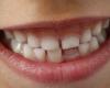 Qu’est-ce que le MIH, cette maladie qui détruit l’émail des dents des enfants et favorise les caries ?