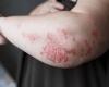 Zasocitinib, un autre inhibiteur de Tyk2 pour traiter le psoriasis oral