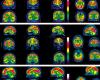 Ce que l’on sait de l’impact du Covid sur votre cerveau